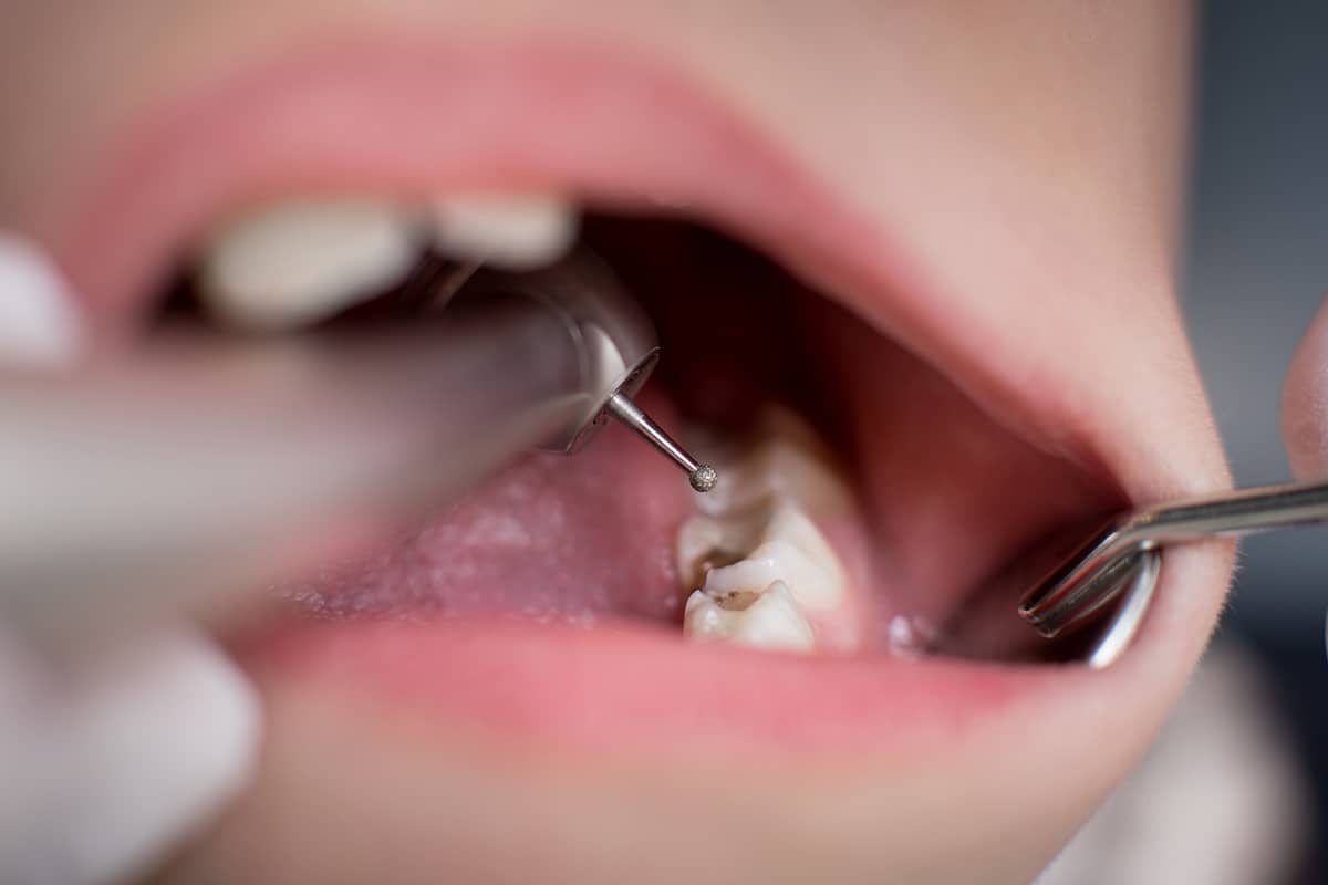 How long do dental fillings last replacement guidelines