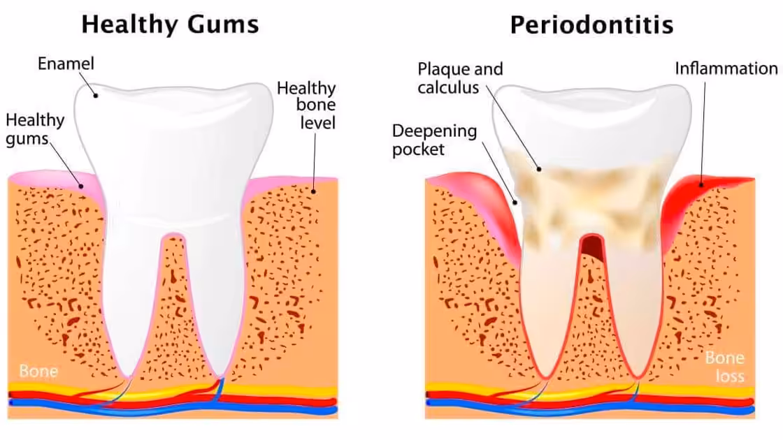Periodontal Stages of Disease Graphic