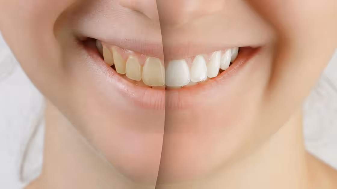 Whitening Before and After