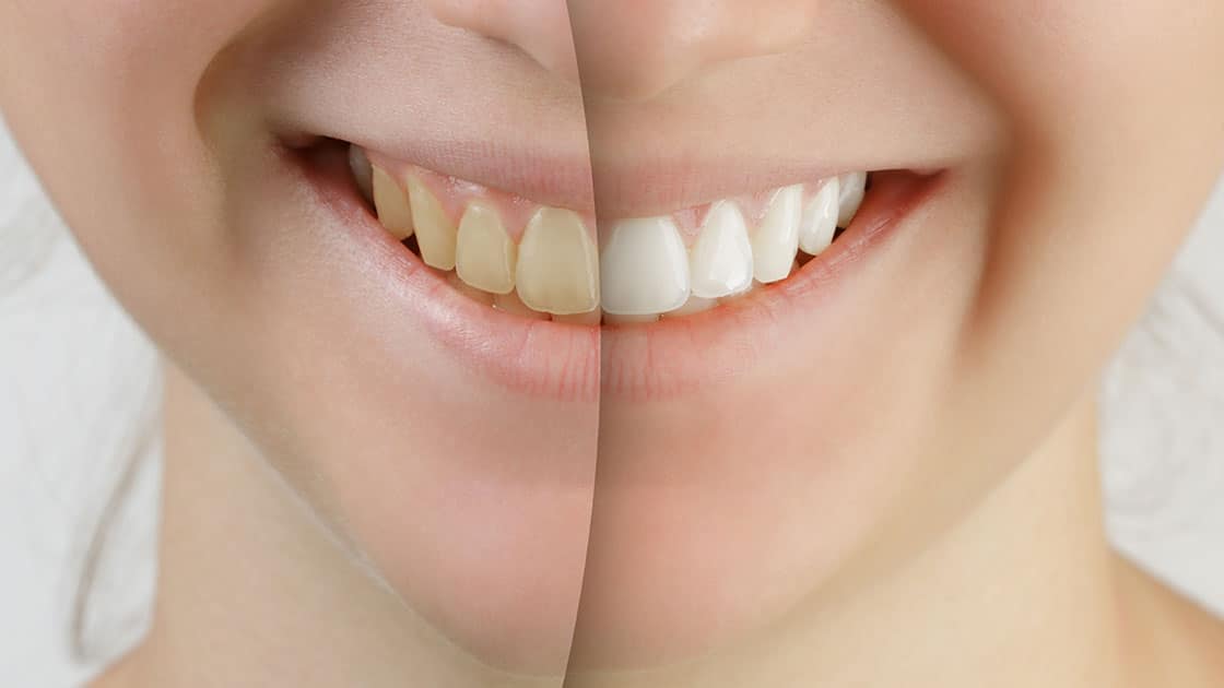 Whitening Before and After